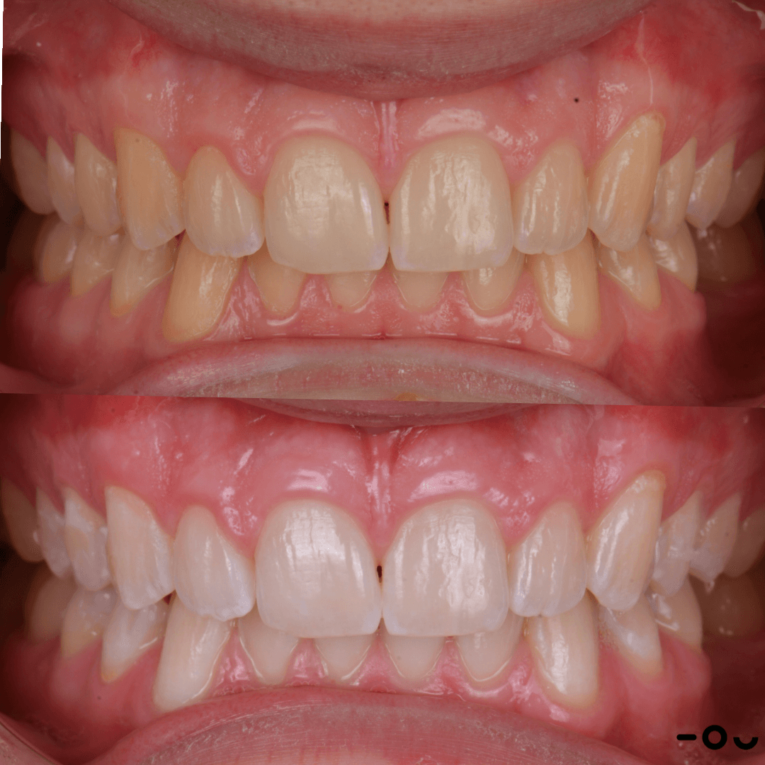 Resultados del blanqueamiento dental profesional en Viladecans