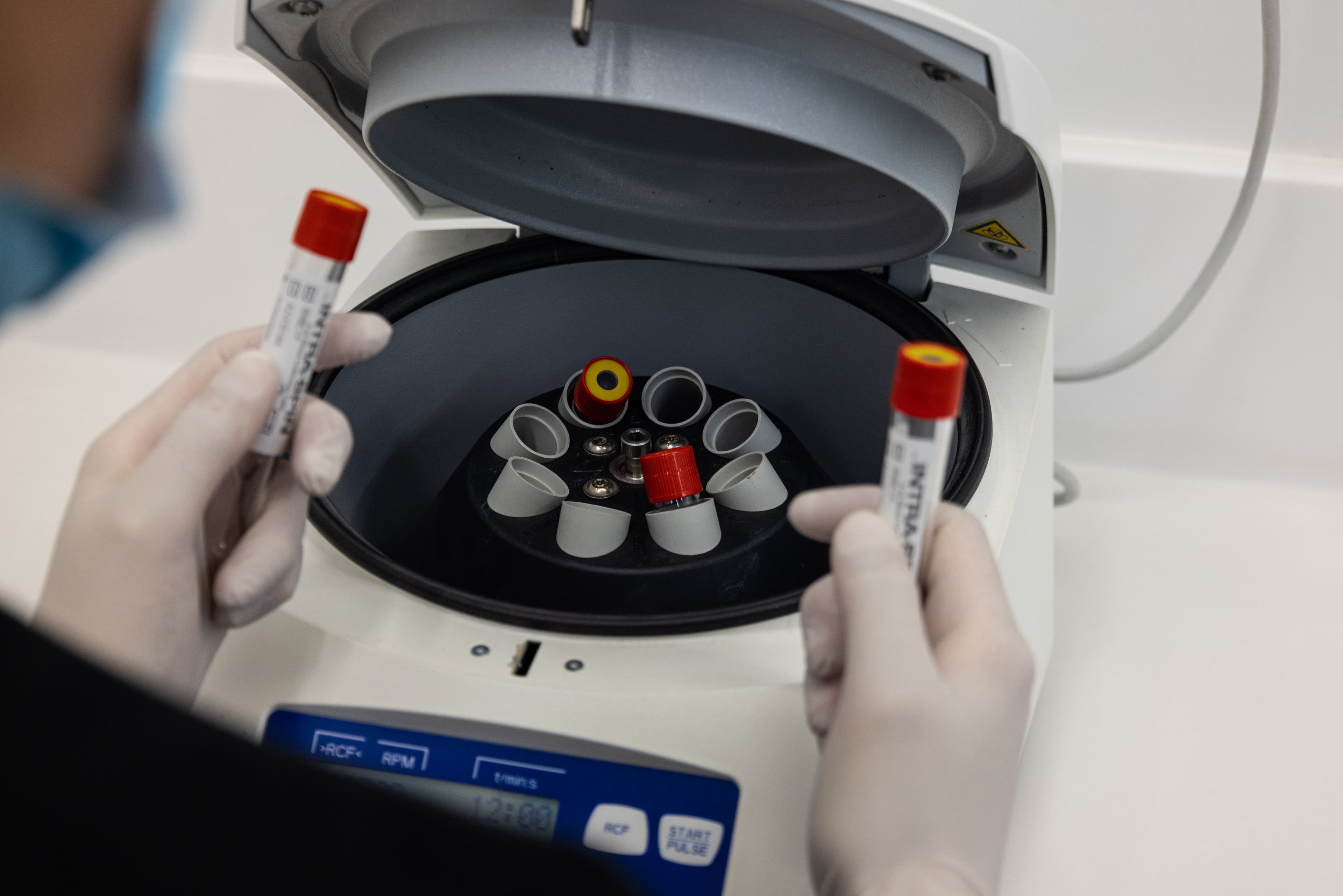 Tecnología 3D para implantes dentales - Clínica Vela-Segalà