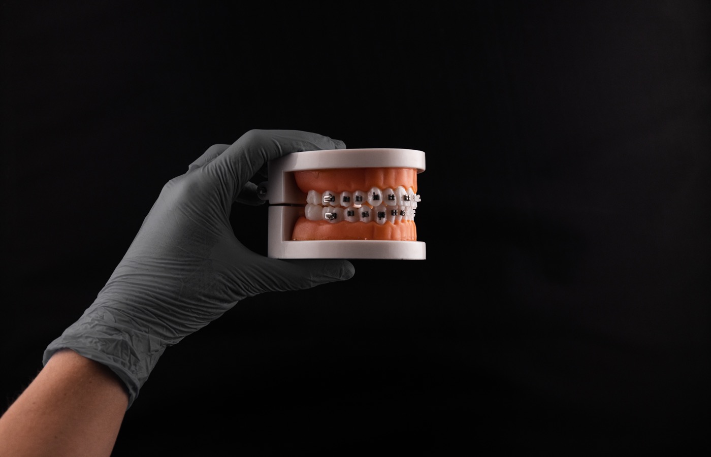Modelo dental con brackets metálicos - ortodoncia Viladecans