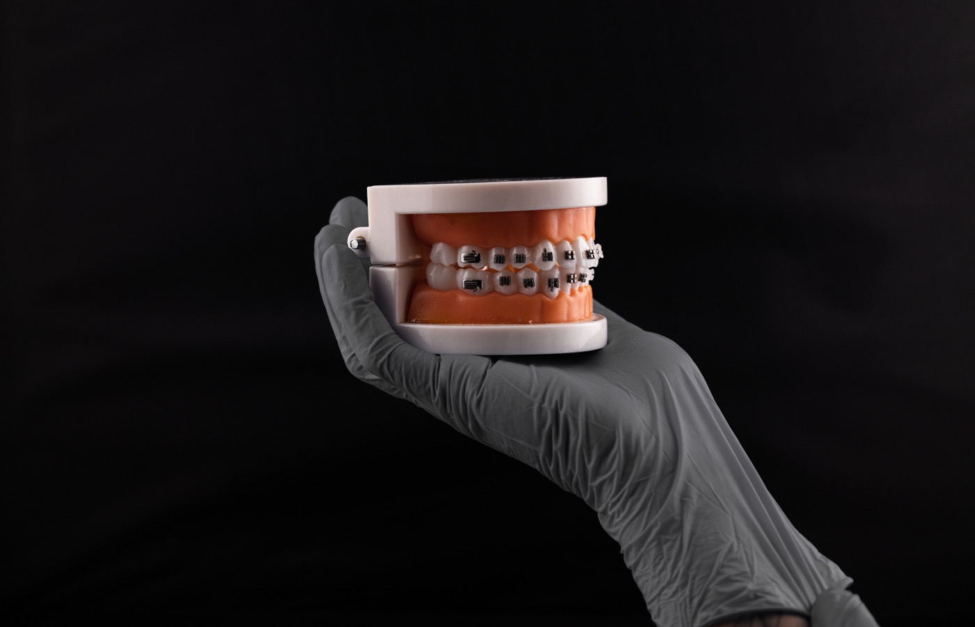 Modelo de ortodoncia con brackets - Clínica Vela-Segalà Viladecans